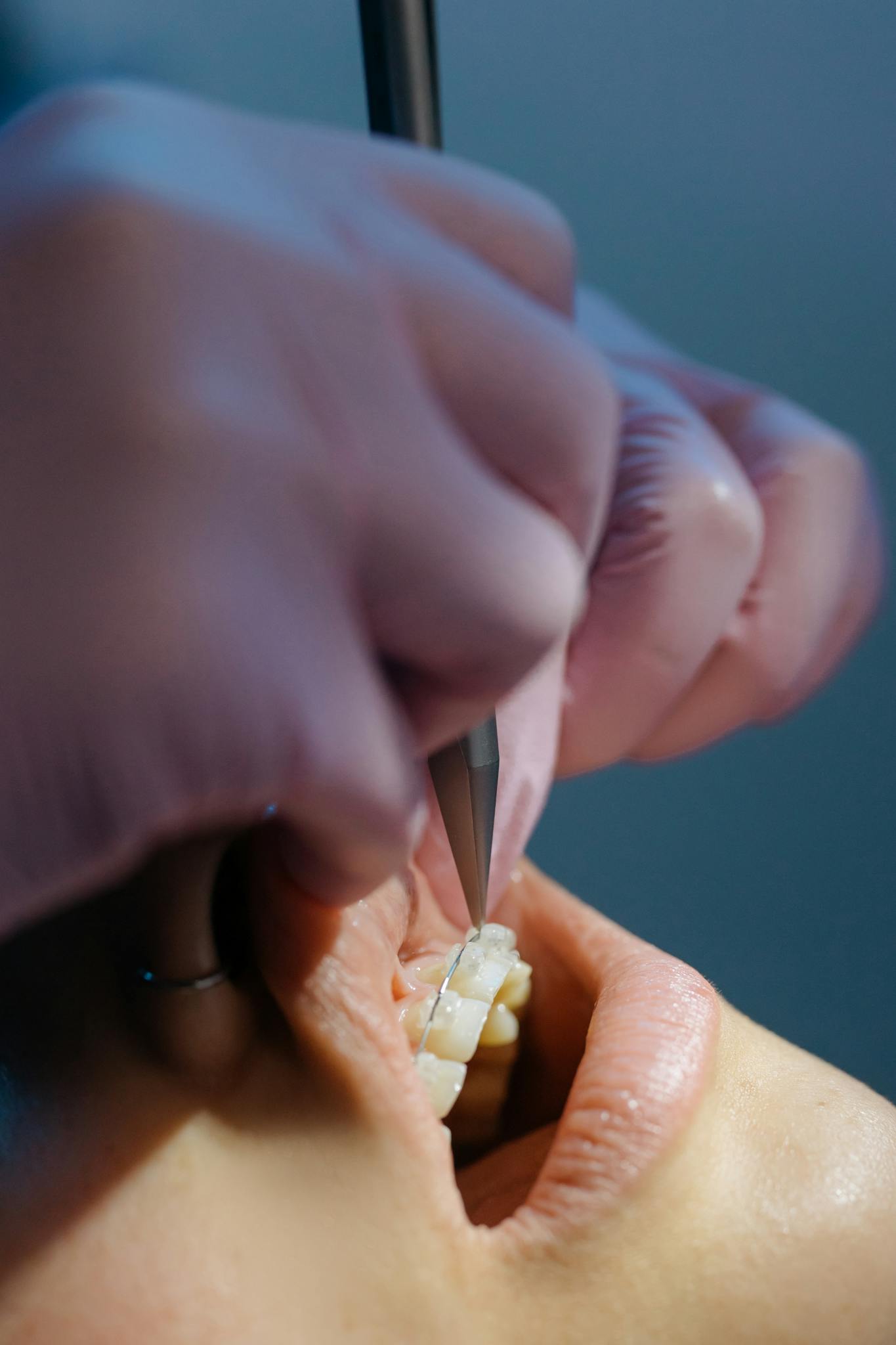 Detailed view of dentist performing dental procedure with precision instrument.